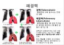 호흡기질환, 폐결핵, 폐결핵 병태생리, 간호진단 및 간호중재 4페이지