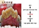 흡연이 구강에 미친는 영향 PPT 5페이지