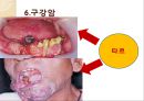 흡연이 구강에 미친는 영향 PPT 9페이지
