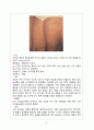 [아동간호학][Purpura][자반증]케이스스터디(Case Study), 문헌고찰 3페이지