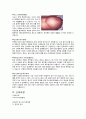 [성인간호학][Liver cirrhosis][간경화] 케이스 스터디(Case Study), 문헌고찰 6페이지