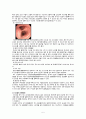[성인간호학][Esophageal cancer][식도암] 케이스 스터디(Case Study), 문헌고찰 5페이지