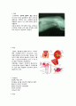 [성인간호학][Renal pelvic stones ][신우결석]케이스 스터디(Case Study),신루관(Nephrostomy tube)관리,신우절제술 2페이지