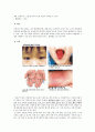 [아동간호학][가와사키][Kawasaki] 케이스 스터디(Case Study), 문헌고찰 2페이지