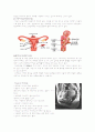 [모성학] 자궁근종 (myoma uteri=leiomyoma)  2페이지