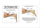 아킬레스 건염 재활 운동 (Achilles Tendinitis 정의, 원인, 진단, 분류, Paratenonitis(건주위염)치료, Tendinosis(퇴행성 건염) 치료, Achilles Tendon Rupture 정의, 증상, 아킬레스건 수술, 재활 운동).PPT자료 6페이지