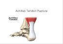 아킬레스 건염 재활 운동 (Achilles Tendinitis 정의, 원인, 진단, 분류, Paratenonitis(건주위염)치료, Tendinosis(퇴행성 건염) 치료, Achilles Tendon Rupture 정의, 증상, 아킬레스건 수술, 재활 운동).PPT자료 20페이지
