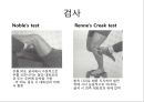 무릎의 신체 검진 및 질환 소개.PPT자료 38페이지
