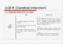 뇌경색 (Cerebral Infarction) 케이스  35페이지