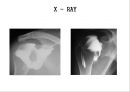 오십견 재활 운동 (Adhesive capsulitis, 1단계 통증 경감 시기, 2단계 적극적 가동범위 회복, 3단계 견갑대 강화 시기).PPT자료 10페이지