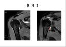 오십견 재활 운동 (Adhesive capsulitis, 1단계 통증 경감 시기, 2단계 적극적 가동범위 회복, 3단계 견갑대 강화 시기).PPT자료 11페이지