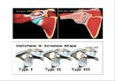 충돌 증후군 재활 운동 (정의, 원인, 진단, 치료, Neer의 Impingement syndrome 세 단계 분류, 재활운동, 1단계 어깨 스트레칭, 2단계 어깨 체형 교정, 3단계 어깨 견갑대 강화 운동).pptx 7페이지