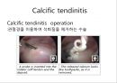 회선근개 재활 운동 (어깨 수술의 이해 Shoulder operation, 어깨 재활 운동 0~2주 재활운동, ROM Exercise, 스트레칭 Stretching, Simple EX 10분).PPT자료 10페이지