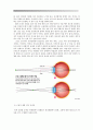 VDT 증후군 - 정의, 종류, 치료법, 예방 방법 : 안구 건조증, 근시, 두통, 거북목, 근막 동통, 요통 5페이지