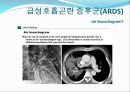 ARDS(급성호흡곤란 증후군)의 환자간호 (History, 진단적 기준, 발병률, 사망률, 원인, 병태생리, 기계적 치료, 내과적 치료).PPT자료 13페이지