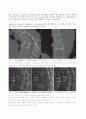 척추 무혈성 괴사 Kummell`s Disease (Vertebral Osteonecrosis) 2페이지