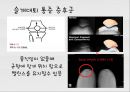 대퇴사두각(q angle)의 증가로 인한 부상의 종류 4페이지