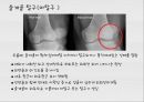 대퇴사두각(q angle)의 증가로 인한 부상의 종류 8페이지