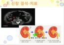 비뇨기계 질환과 간호 (신장 결석, 요관결석, 요로감염, 신장암, 방광염, 방광암, 과민성 방광, 요실금, 방광 결석, 방광요관역류, 전립선 비대증, 전립선염, 전립선 암, 음낭 질환, 고환암, 요도 협착).pptx 12페이지
