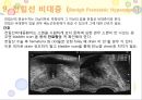 비뇨기계 질환과 간호 (신장 결석, 요관결석, 요로감염, 신장암, 방광염, 방광암, 과민성 방광, 요실금, 방광 결석, 방광요관역류, 전립선 비대증, 전립선염, 전립선 암, 음낭 질환, 고환암, 요도 협착).pptx 72페이지