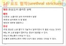 비뇨기계 질환과 간호 (신장 결석, 요관결석, 요로감염, 신장암, 방광염, 방광암, 과민성 방광, 요실금, 방광 결석, 방광요관역류, 전립선 비대증, 전립선염, 전립선 암, 음낭 질환, 고환암, 요도 협착).pptx 88페이지