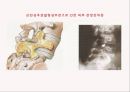 (스포츠의학, 운동처방관련학과) Spondylolisthesis 척추전방전위증 -정의 원인 증상 및 운동방법 7페이지