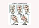 (스포츠의학, 운동처방관련학과) Spondylolisthesis 척추전방전위증 -정의 원인 증상 및 운동방법 10페이지