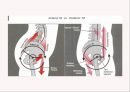 (스포츠의학, 운동처방관련학과) Spondylolisthesis 척추전방전위증 -정의 원인 증상 및 운동방법 20페이지