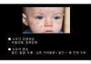 감염성 질환의 예방 및 치료,-수두 & 매독ppt자료 3페이지
