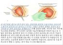 [수술실 케이스 컨퍼런스 (Case Conference)] 갑상선암 / 갑상선절제술.pptx 21페이지