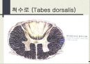 척수로(Tabes dorsalis) & 척수공동증(Syringomyelia)  2페이지