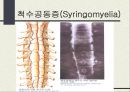 척수로(Tabes dorsalis) & 척수공동증(Syringomyelia)  14페이지