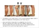[스포츠의학관련] 의자 스트레칭 , 하지정맥류 24페이지
