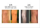 [스포츠의학관련] 의자 스트레칭 , 하지정맥류 26페이지