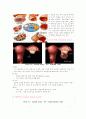간호학 케이스 스터디 -난소종양(ovarian tumors) 3페이지
