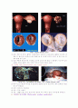 간호학 케이스 스터디 -난소종양(ovarian tumors) 4페이지