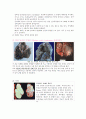 간호학 케이스 스터디 -난소종양(ovarian tumors) 10페이지