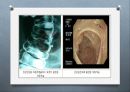 위장관계 환자의 사정과 간호 (위장계, 게실질환, 맥켈게실, appendicitis, PUD, 위궤양, 십이지장궤양, 급성 복막염, 위장관 출혈, 탈장, 크론병 & 궤양성 대장염, 위장관 출혈 case study).pptx
 6페이지