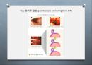 위장관계 환자의 사정과 간호 (위장계, 게실질환, 맥켈게실, appendicitis, PUD, 위궤양, 십이지장궤양, 급성 복막염, 위장관 출혈, 탈장, 크론병 & 궤양성 대장염, 위장관 출혈 case study).pptx
 37페이지