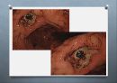 위장관계 환자의 사정과 간호 (위장계, 게실질환, 맥켈게실, appendicitis, PUD, 위궤양, 십이지장궤양, 급성 복막염, 위장관 출혈, 탈장, 크론병 & 궤양성 대장염, 위장관 출혈 case study).pptx
 52페이지