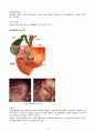 CBD Ca, ampullary ca, ERCP , ,  담도암(담관암) CBD cancer 케이스 스터디 5페이지