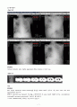 간질 성 폐질환 ILD : Interstitial lung disease 케이스 스터디 (Case Study) 7페이지