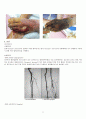 buerger's disease의 증상과 치료 2페이지