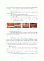 [암간호] 위암 (암의 정의 및 발생률, 위의 위치와 구조, 위암의 정의 및 종류, 위암의 발생빈도, 위험요인, 증상, 병기별 분류, 진단 방법, 치료 방법, 치료의 부작용, 재발 및 전이, 치료 현황, 예방법) 6페이지