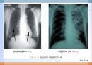 호흡기질환(임상영양학, 호흡기구조, 호흡기질환종류, 치료, 약물치료) PPT, 파워포인트 21페이지