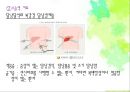 [담석 (Gallstone)]  담석과 담석증의 정의, 담석증의 원인,담석 종류별 기전, 담석증의 증상, 담석증의 진단, 담석증의 치료법과 예방법.pptx 19페이지
