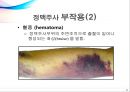 정맥주사요법 (부위,과정,부작용,영상) 17페이지