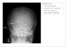 방사선사 국가고시 일반촬영 정리 (일반 영상검사, 일반 촬영, Lower extremity, Hip & pelvis, Spine, Mamo 촬영, 일반촬영 모의고사).ppt 7페이지