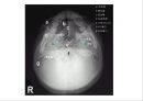 방사선사 국가고시 일반촬영 정리 (일반 영상검사, 일반 촬영, Lower extremity, Hip & pelvis, Spine, Mamo 촬영, 일반촬영 모의고사).ppt 9페이지