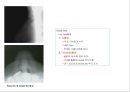방사선사 국가고시 일반촬영 정리 (일반 영상검사, 일반 촬영, Lower extremity, Hip & pelvis, Spine, Mamo 촬영, 일반촬영 모의고사).ppt 13페이지